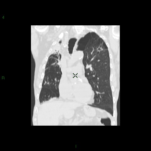 File:Aspergilloma (Radiopaedia 14842-14787 Coronal lung window 15).jpg