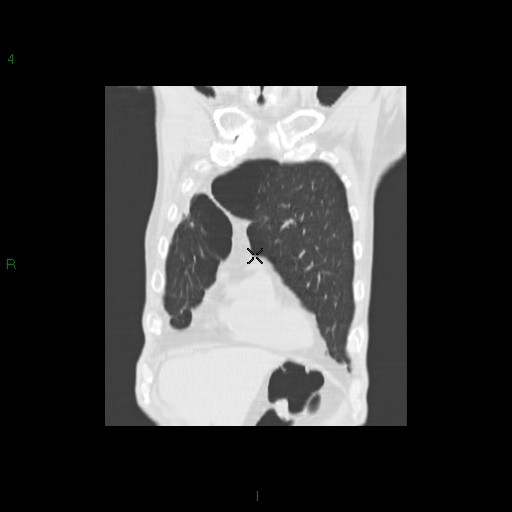 File:Aspergilloma (Radiopaedia 14842-14787 Coronal lung window 7).jpg
