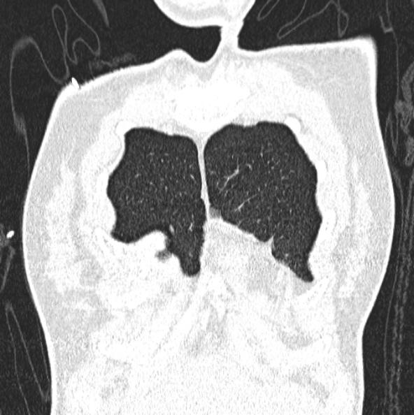 File:Aspergilloma (Radiopaedia 26223-26347 Coronal lung window 8).jpg
