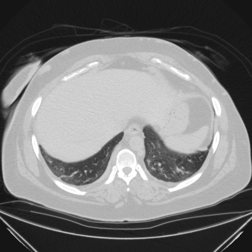 Aspergilloma (Radiopaedia 39611-41932 Axial lung window 113).jpg