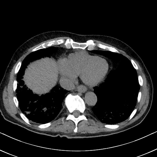 File:Aspergilloma on background pulmonary fibrosis (Radiopaedia 60942-68757 Axial non-contrast 43).jpg