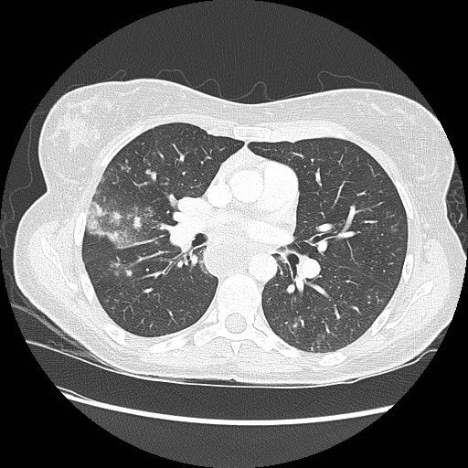 Aspiration pneumonia secondary to laparoscopic banding (Radiopaedia 18345-18183 lung window 52).jpg