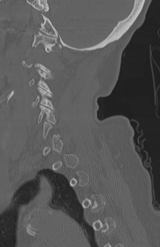 Atlanto-axial subluxation (Radiopaedia 36610-38176 Sagittal bone window 26).png