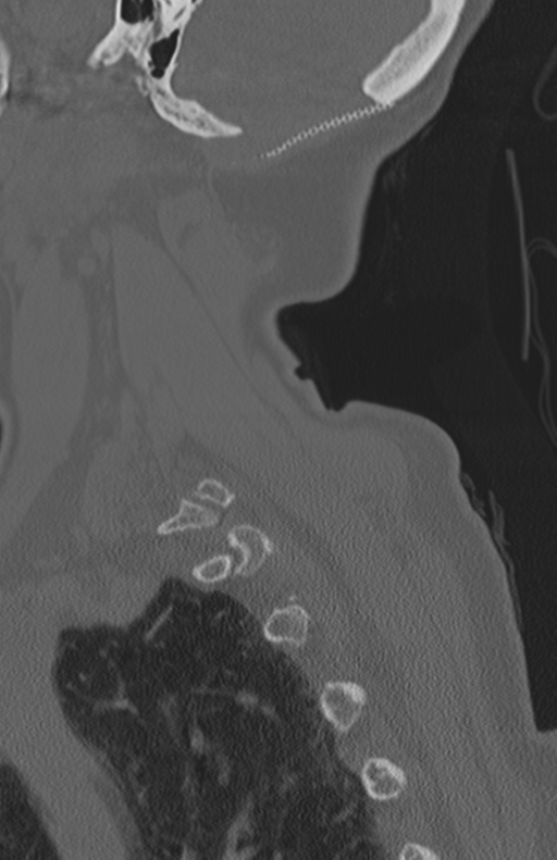 Atlanto-axial subluxation (Radiopaedia 36610-38176 Sagittal bone window 66).png