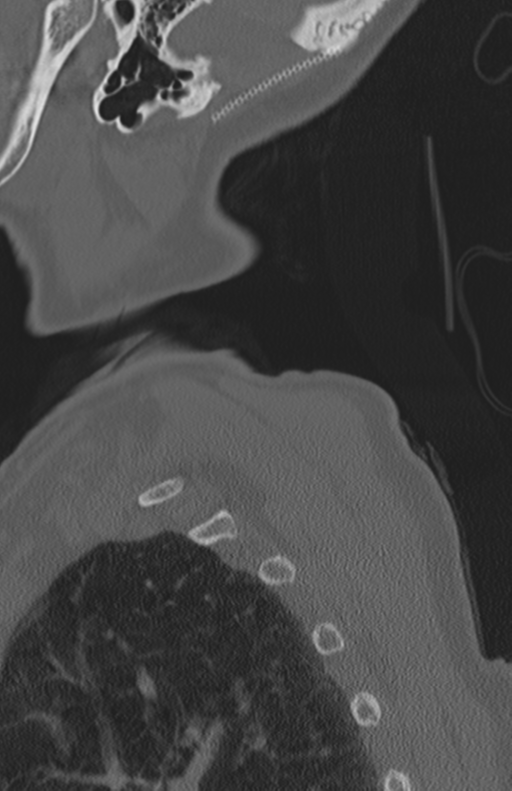 Atlanto-axial subluxation (Radiopaedia 36610-38176 Sagittal bone window 73).png