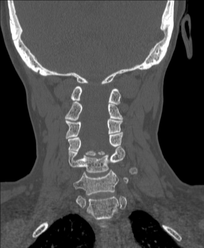 Atlanto-occipital assimilation with basilar invagination (Radiopaedia 70122-80188 Coronal bone window 132).jpg