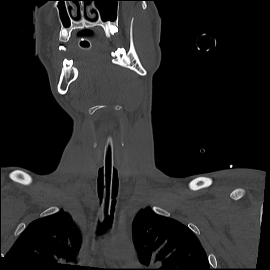 Atlanto-occipital dissociation (Traynelis type 1), C2 teardrop fracture, C6-7 facet joint dislocation (Radiopaedia 87655-104061 Coronal bone window 19).jpg