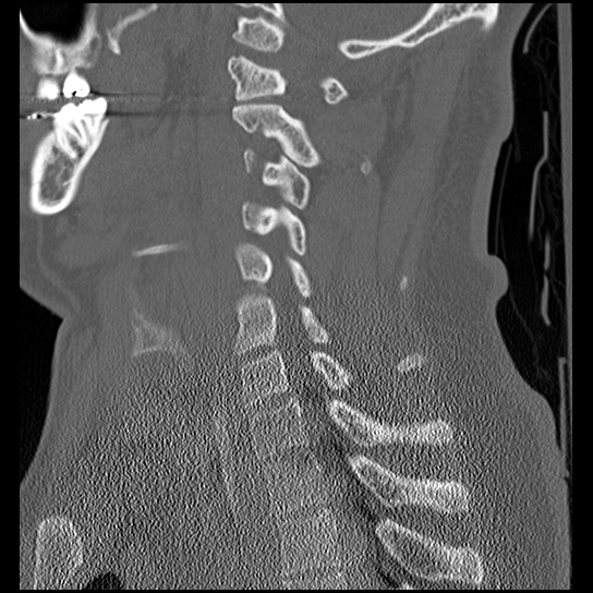 Atlanto-occipital dissociation injury (Radiopaedia 29274-29698 Sagittal bone window 36).png