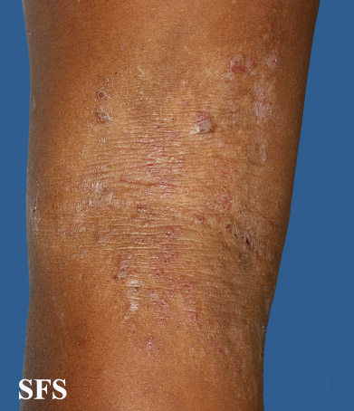 Atopic Dermatitis (Dermatology Atlas 36).jpg