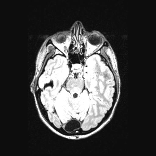 Atretic encephalocoele with inferior vermis hypoplasia (Radiopaedia 30443-31108 Axial 57).jpg