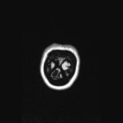 Atretic encephalocoele with inferior vermis hypoplasia (Radiopaedia 30443-31108 Coronal FLAIR 13).jpg