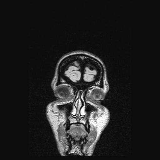 Atretic encephalocoele with inferior vermis hypoplasia (Radiopaedia 30443-31108 Coronal FLAIR 169).jpg