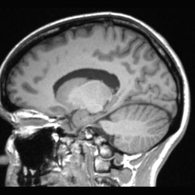 Atretic encephalocoele with inferior vermis hypoplasia (Radiopaedia 30443-31108 Sagittal T1 53).jpg