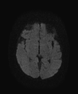 File:Atretic parietal cephalocele (Radiopaedia 64350-73135 Axial DWI 11).jpg