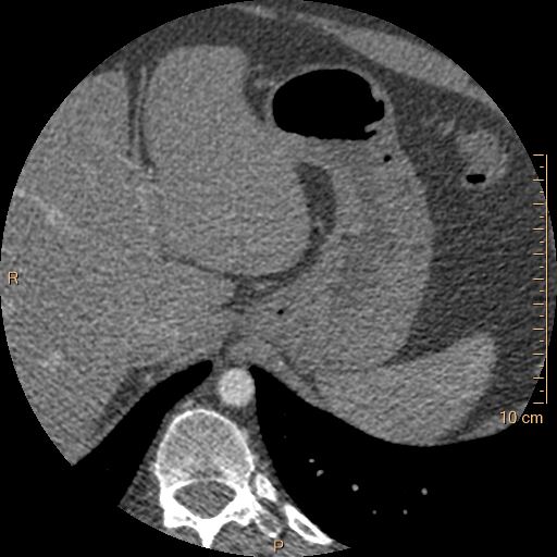 Atrial septal defect (upper sinus venosus type) with partial anomalous pulmonary venous return into superior vena cava (Radiopaedia 73228-83961 A 300).jpg