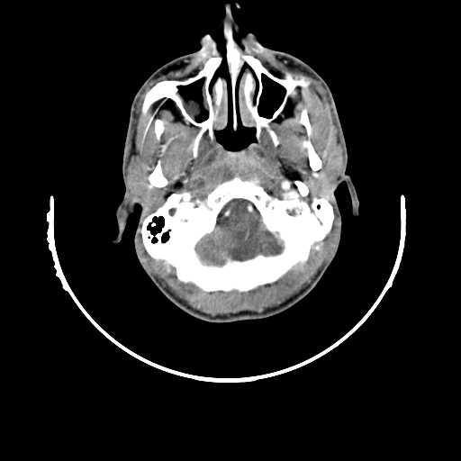 File:Atypical 2nd branchial cleft cyst (type IV) - infected (Radiopaedia 20986-20924 A 1).jpg