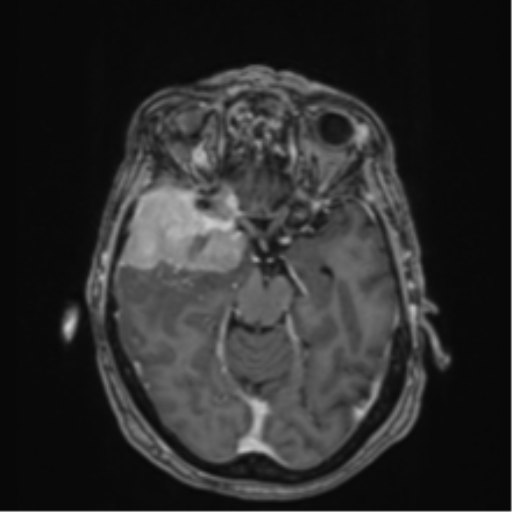 Atypical meningioma (WHO Grade II) (Radiopaedia 54742-60979 Axial T1 C+ 23).png