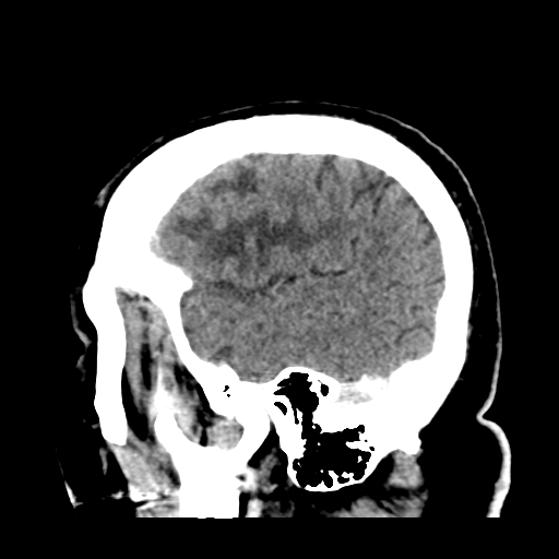 Atypical meningioma (WHO grade II) with brain invasion (Radiopaedia 57767-64728 Sagittal C+ 9).png