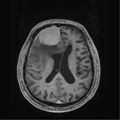 File:Atypical meningioma (WHO grade II) with brain invasion (Radiopaedia 57767-64729 Axial T1 C+ 29).png