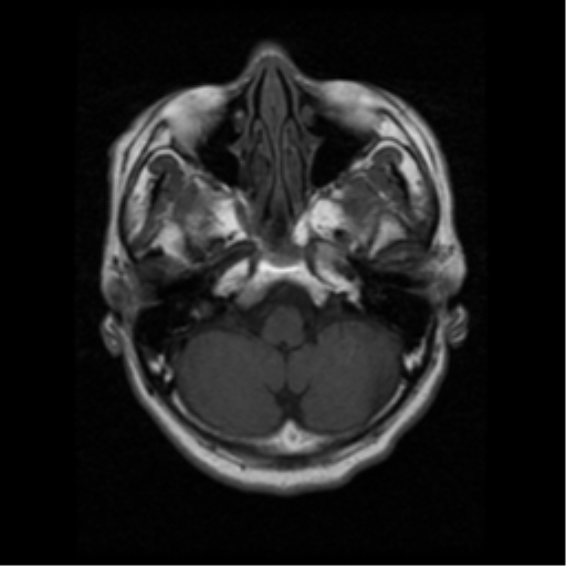File:Atypical meningioma (WHO grade II) with osseous invasion (Radiopaedia 53654-59716 Axial T1 4).png