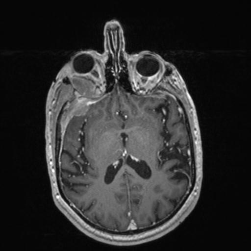 Atypical meningioma (grade II) - en plaque (Radiopaedia 29633-30147 Axial T1 C+ 102).jpg