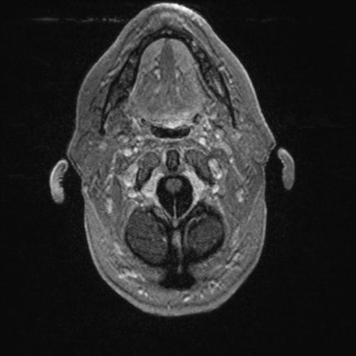 Atypical meningioma (grade II) - en plaque (Radiopaedia 29633-30147 Axial T1 C+ 18).jpg