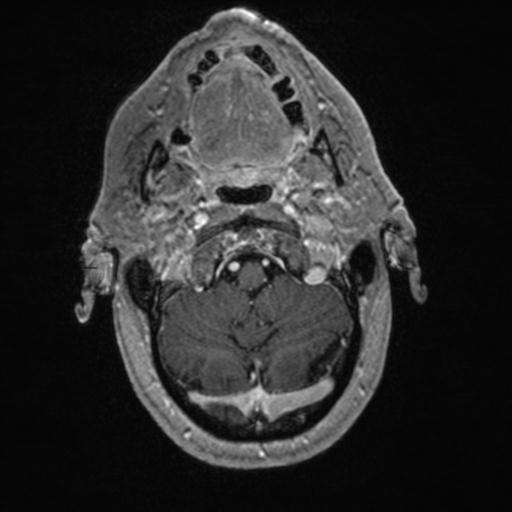 Atypical meningioma (grade II) - en plaque (Radiopaedia 29633-30147 Axial T1 C+ 29).jpg