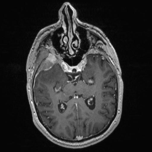Atypical meningioma (grade II) - en plaque (Radiopaedia 29633-30147 Axial T1 C+ 84).jpg