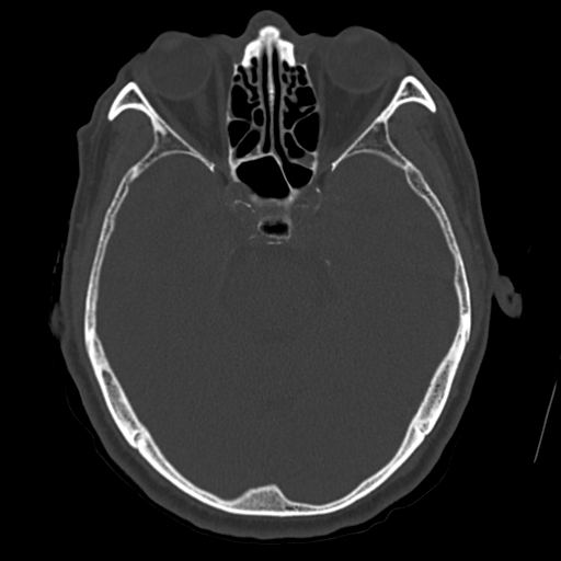 Atypical meningioma with skull invasion (Radiopaedia 34357-35649 Axial bone window 29).png