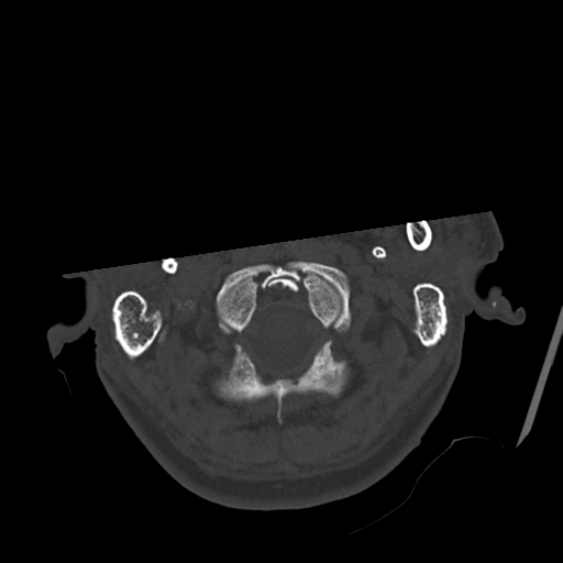 Atypical meningioma with skull invasion (Radiopaedia 34357-35649 Axial bone window 8).png
