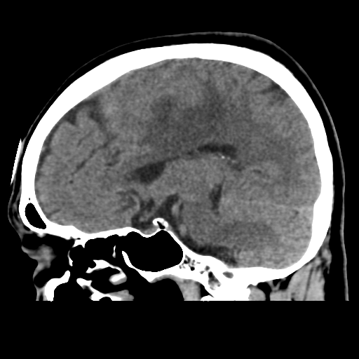 Atypical meningioma with skull invasion (Radiopaedia 34357-35649 E 25).png