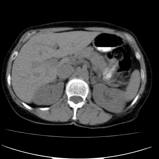 File:Atypical renal cyst (Radiopaedia 17536-17251 non-contrast 8).jpg