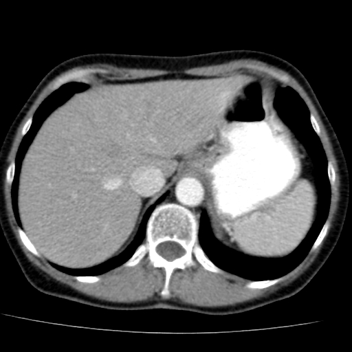 File:Atypical renal cyst (Radiopaedia 17536-17251 renal cortical phase 2).jpg
