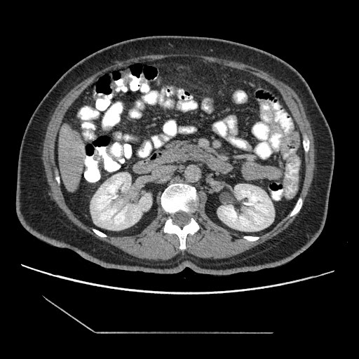 File:Atypical retroperitoneal lymphocoeles with large leiomyoma of uterus (Radiopaedia 32084-33024 A 17).jpg