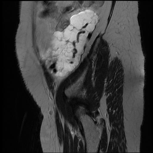 File:Atypical retroperitoneal lymphocoeles with large leiomyoma of uterus (Radiopaedia 32084-33027 Sagittal T2 1).jpg