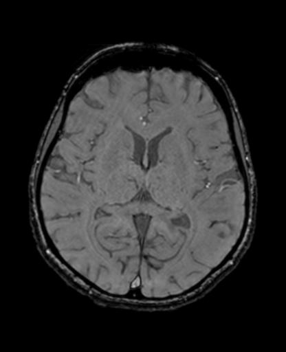 Autoimmune limbic encephalitis (Radiopaedia 30363-31005 SWI - magnitude 42).jpg