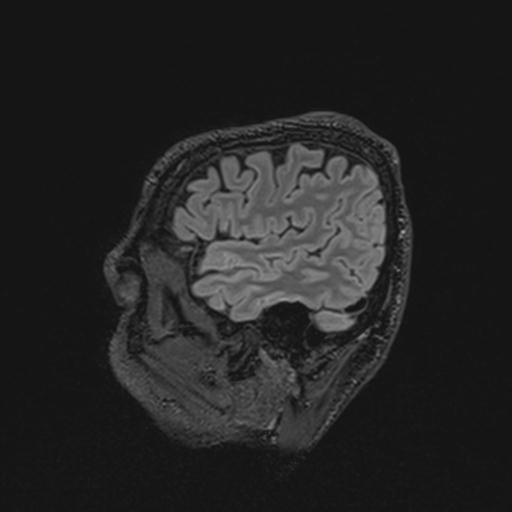 Autoimmune limbic encephalitis (Radiopaedia 30363-31005 Sagittal FLAIR 32).jpg