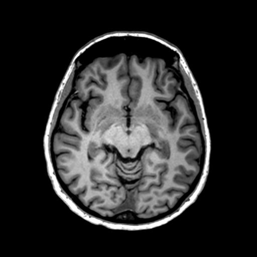 Autoimmune limbic encephalitis (Radiopaedia 30363-31005 T1 Axial 1mm 68).jpg