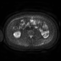 Autoimmune pancreatitis (Radiopaedia 69751-79729 DWI 46).jpg