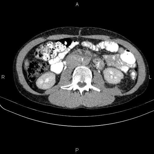 File:Autoimmune pancreatitis (Radiopaedia 84925-100431 Axial C+ delayed 41).jpg