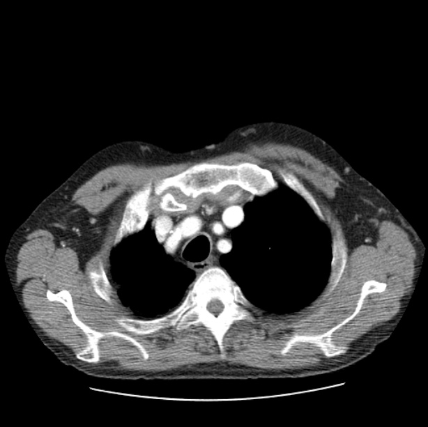 Autosomal dominant polycystic kidney disease (Radiopaedia 27851-28094 B 11).jpg