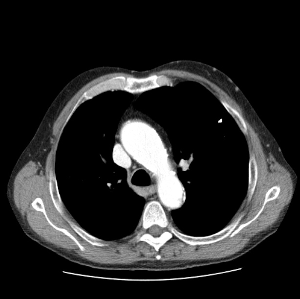 Autosomal dominant polycystic kidney disease (Radiopaedia 27851-28094 B 21).jpg