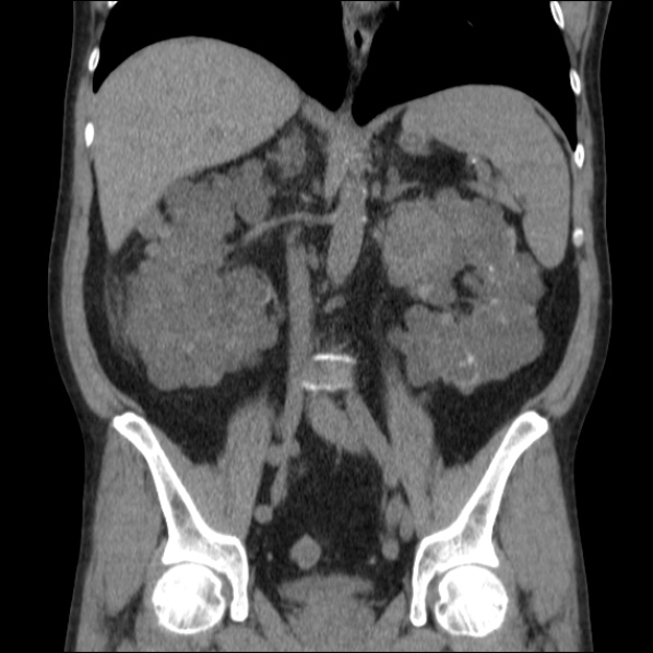 File:Autosomal dominant polycystic kidney disease (Radiopaedia 36539-38101 C 39).jpg