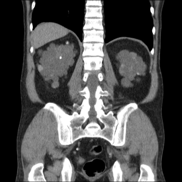 File:Autosomal dominant polycystic kidney disease (Radiopaedia 36539-38101 C 51).jpg