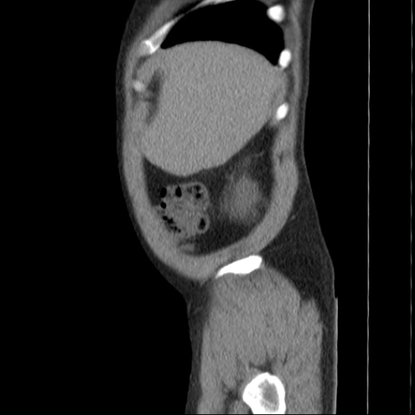 File:Autosomal dominant polycystic kidney disease (Radiopaedia 36539-38101 D 11).jpg