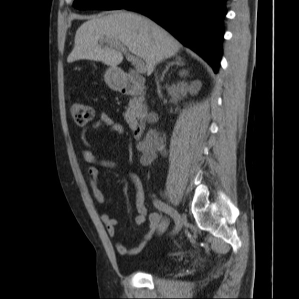 File:Autosomal dominant polycystic kidney disease (Radiopaedia 36539-38101 D 35).jpg