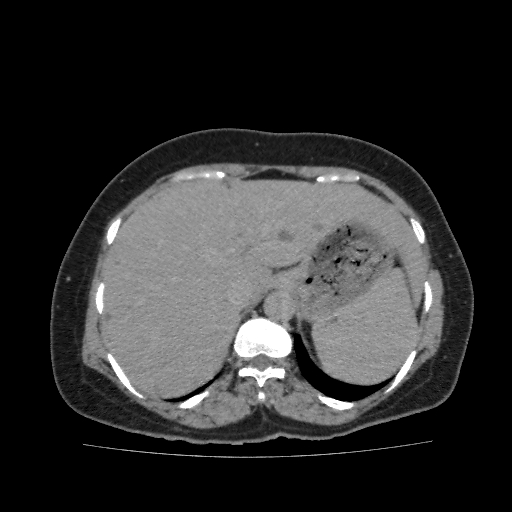 File:Autosomal dominant polycystic kidney disease (Radiopaedia 38189-40194 Axial C+ delayed 5).jpg