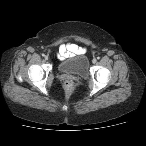 Autosomal dominant polycystic kidney disease with hepatic involvement (Radiopaedia 32693-33662 B 78).jpg