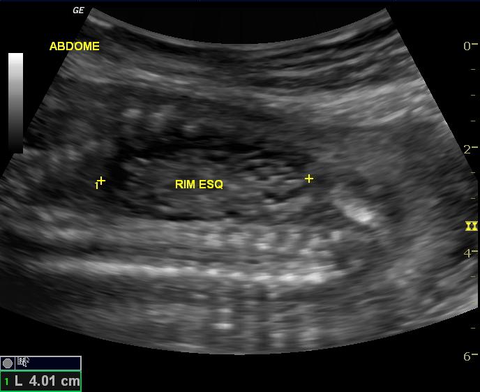 File:Autosomal recessive polycystic kidney disease (antenatal US) (Radiopaedia 12592-12812 Longitudinal 1).jpg