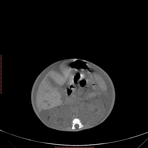 Autosomal recessive polycystic kidney disease associated with Caroli disease (Radiopaedia 61932-69984 B 191).jpg